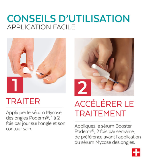 Duo express - Mycose des ongles